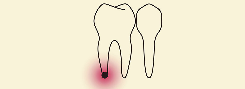 granuloma dentale